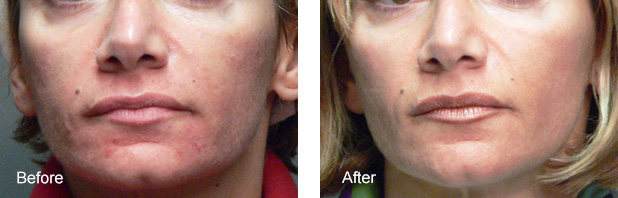 Phtoto-rejuvenation of the face with IPL - before and after treatment photos
